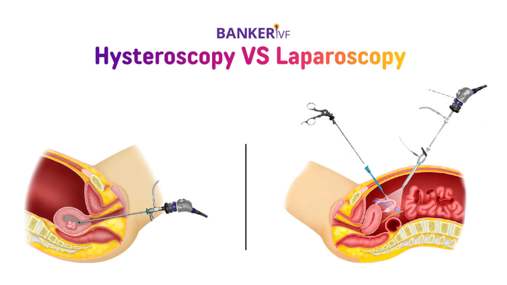 The-Difference-Between-Laparoscopy-and-Hysteroscopy-Banker-IVF