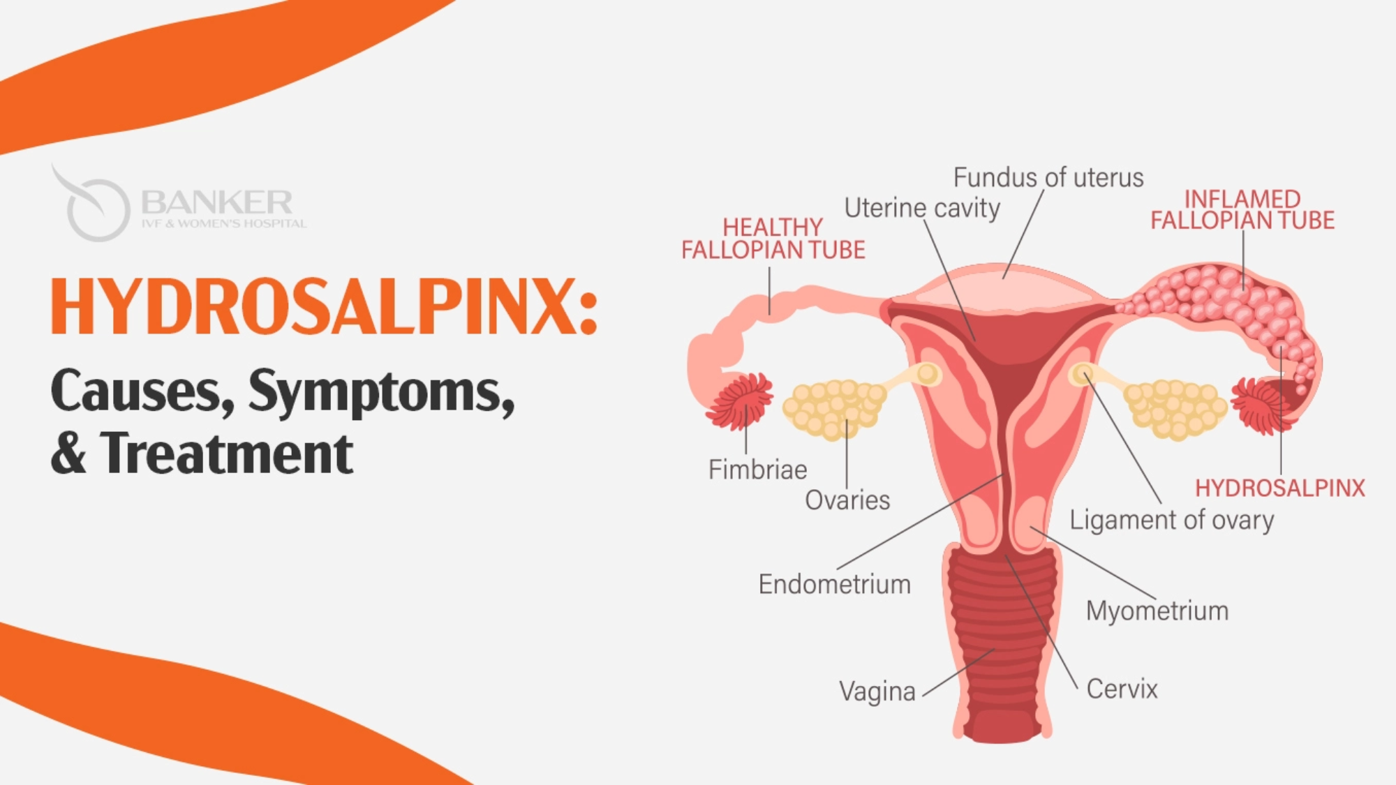 Hydrosalpinx Causes Symptoms