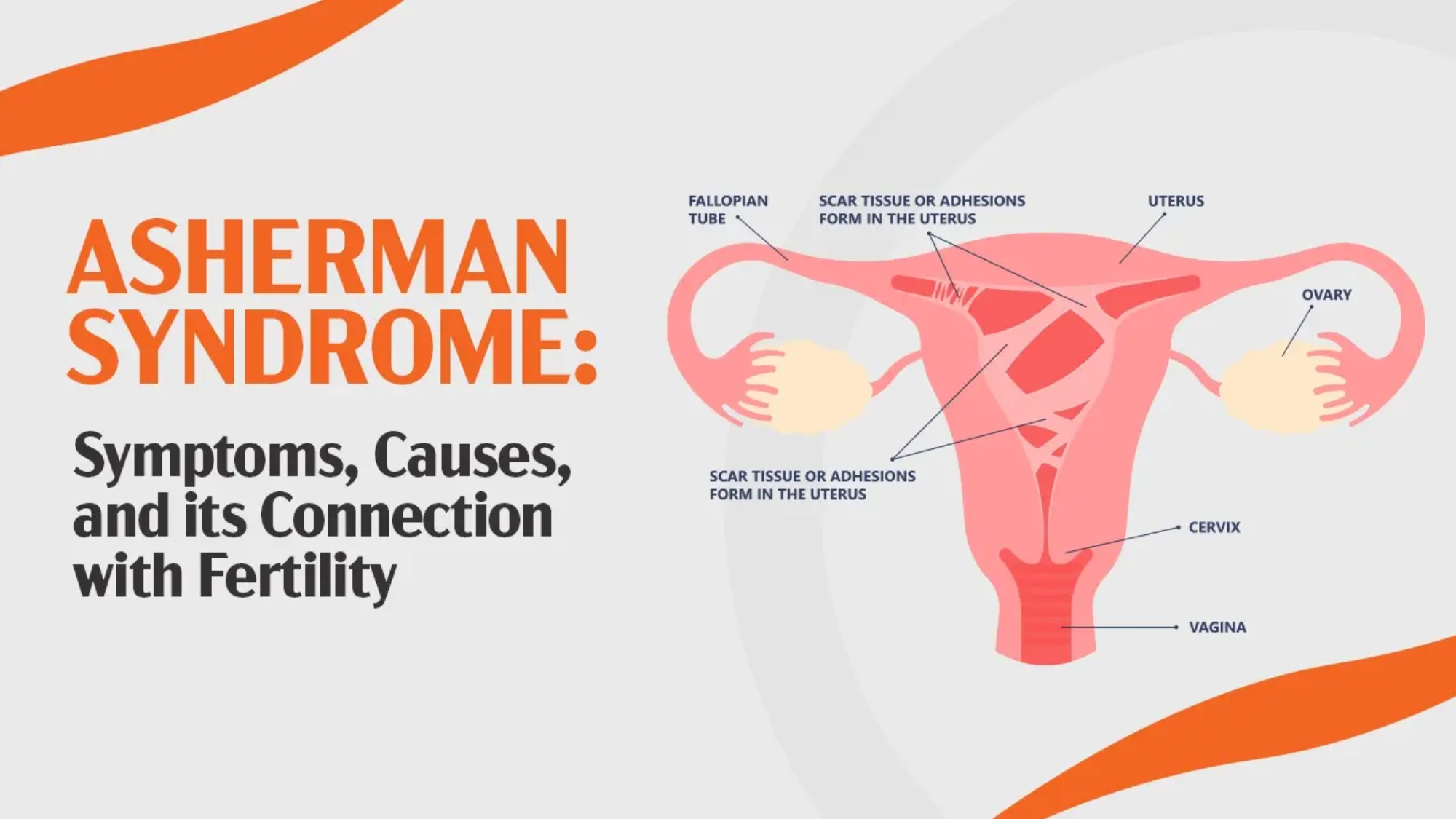 Asherman Syndrome Symptoms Causes
